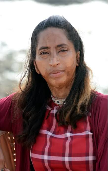 Employment and social reintegration for acid attack survivors