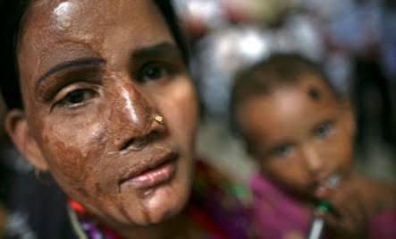 Acid violence awareness and legal prevention support